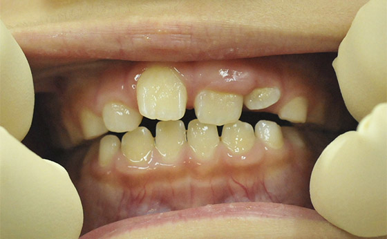 小児歯列矯正 - After