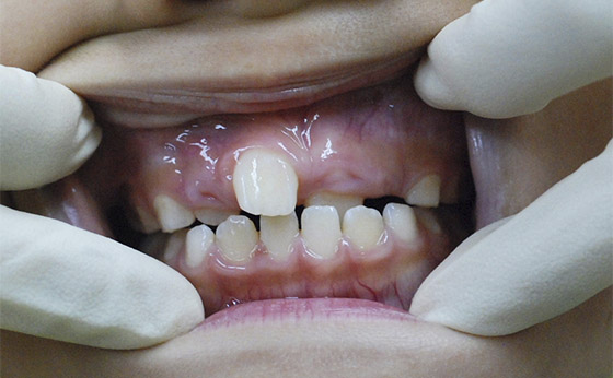 小児歯列矯正 - Before