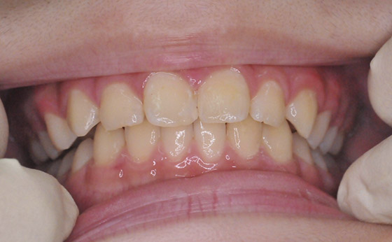 ホワイトニング - After