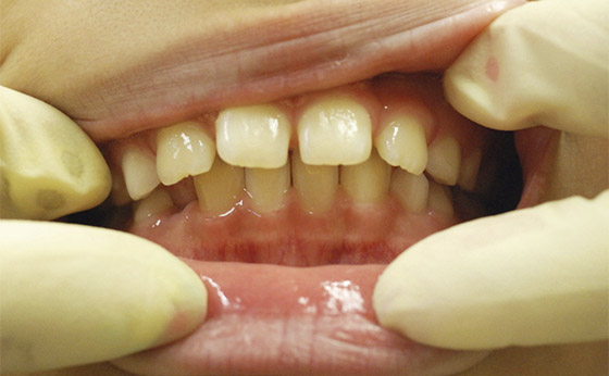 ホワイトニング - Before