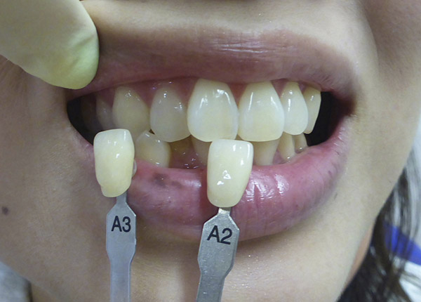 ホワイトニング - After