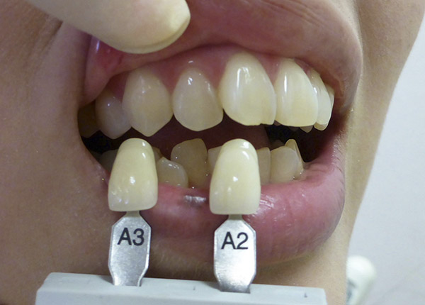 ホワイトニング - Before