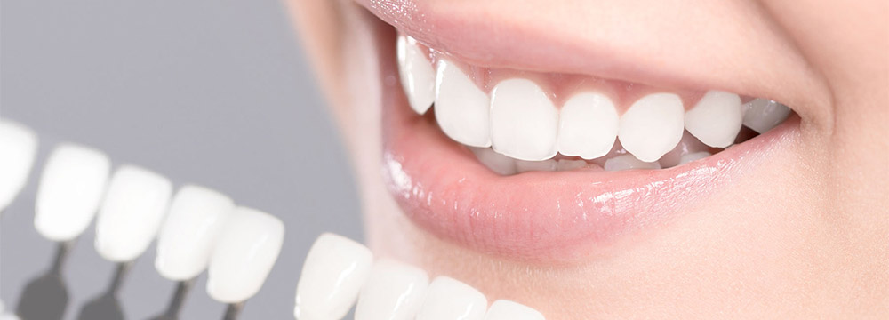 ホワイトニング