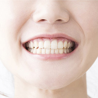 義歯・入れ歯・オールセラミック